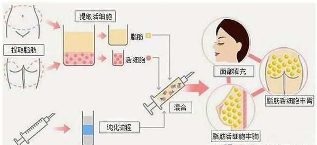 用什么材料隆鼻最自然,哪种材料做隆鼻最自然图8