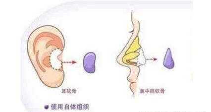 用什么材料隆鼻最自然,哪种材料做隆鼻最自然图10