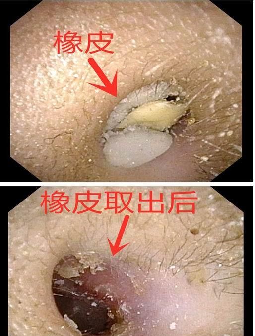 耳朵里的蜜蜂怎么拿出来好(耳朵里的蜜蜂能取出吗)图1